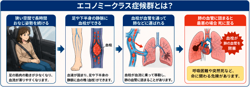 エコノミークラス症候群によって突然の息切れや胸の痛みがおこり、最悪の場合死に繋がります。